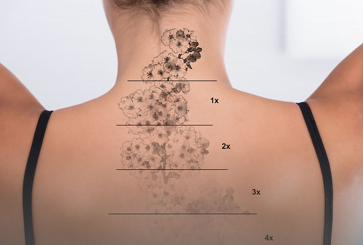 tattoo removal Cape Town
